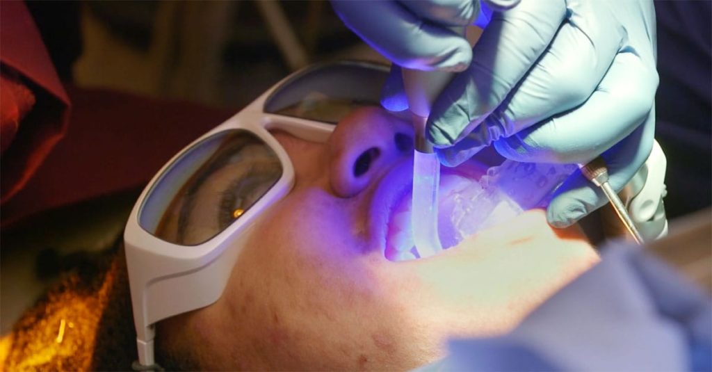 Advantages of Laser Dental Procedures